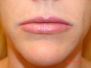 Lip-Implant-After-300x225