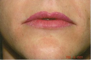 Lip-Implant-Before-300x200